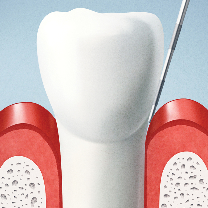 3D graphic demonstrating periodontal treatment on single tooth and gums in general dentistry procedure
