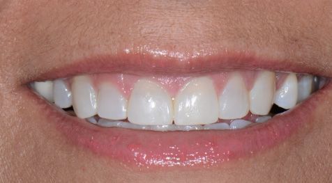 Before and After Dental Bonding - After