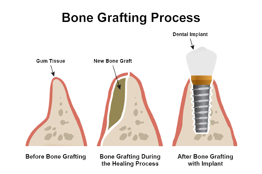 Illustration of bone grafting process