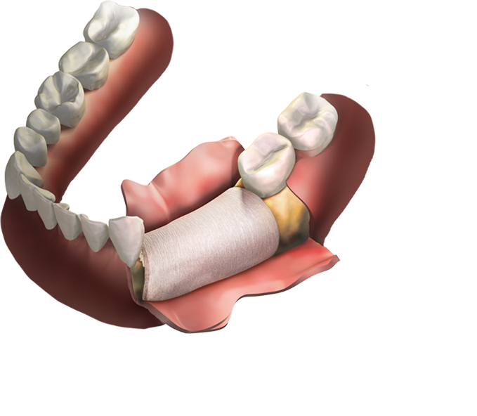 Bone Graft