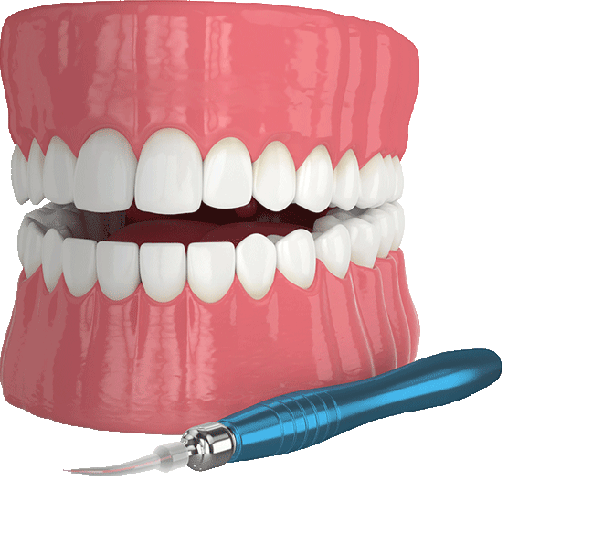 An illustration of a model of the teeth and a dental laser