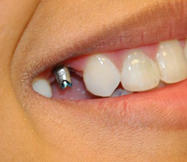 dental implant