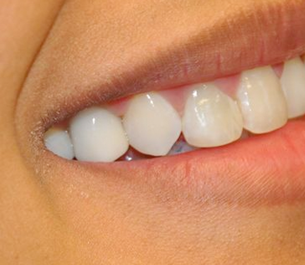restored dental implant