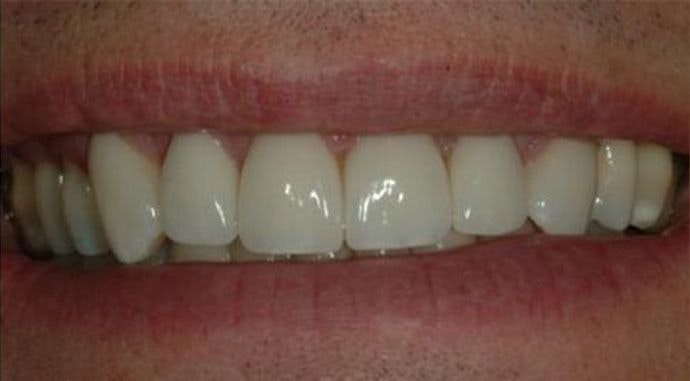 smile after veneers