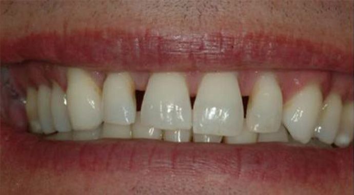smile before veneers
