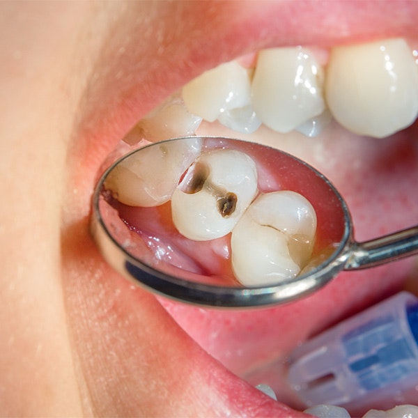Tooth Decay