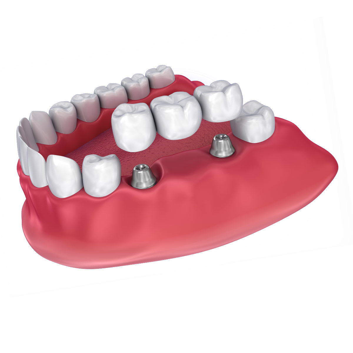 An illustration of an implant-supported bridge