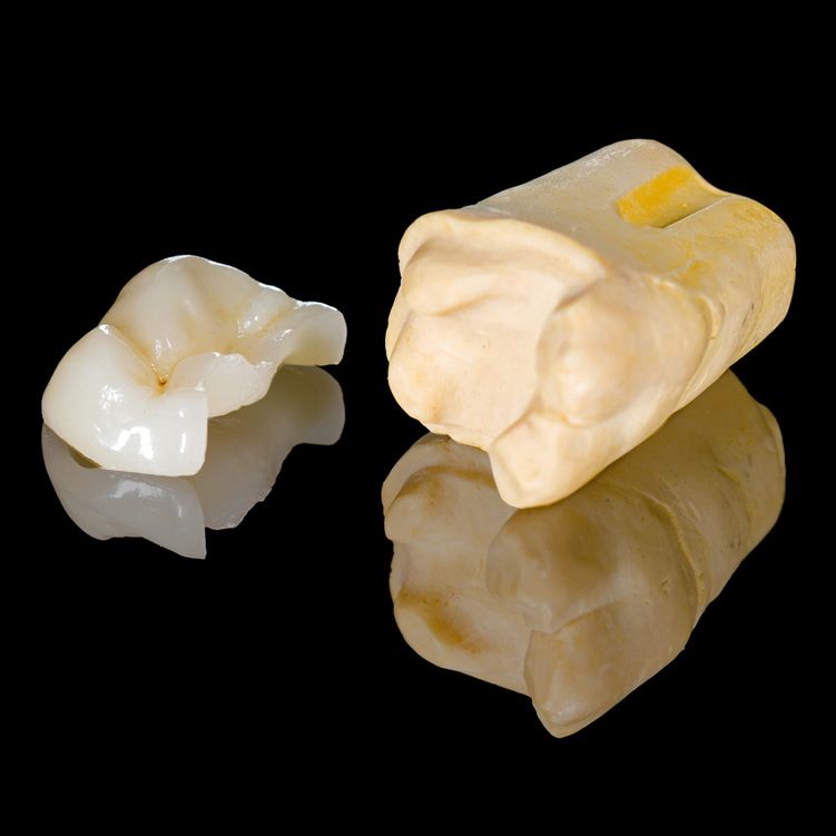 Close up of dental inlay and onlay 
